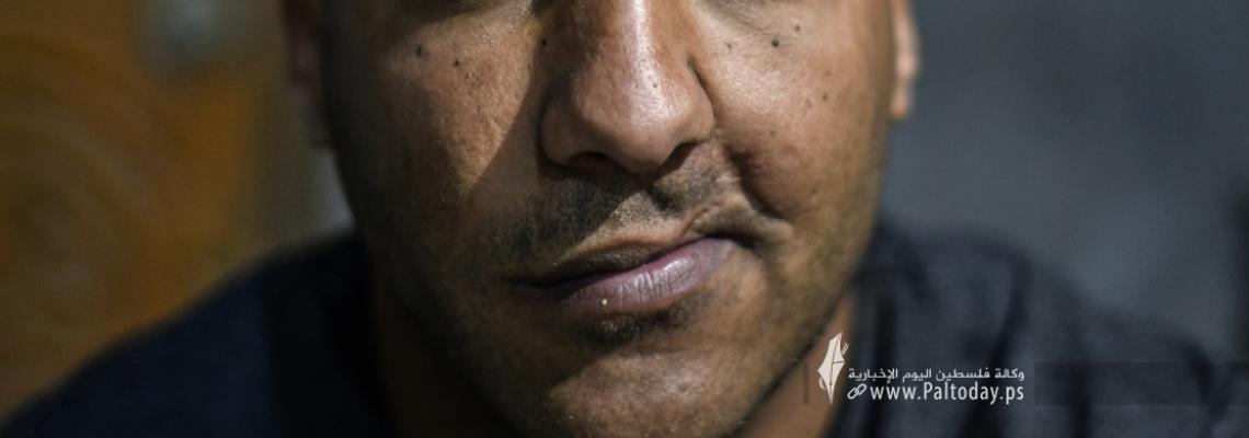 غزة.. قنبلة إسرائيلية تُفقد فلسطينيا فمه وأحلامه