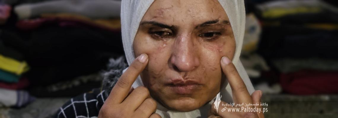 دينا أبو الروس نازحة من شمال غزة فقدت النظر وتعرضت لتشوهات جراء قصف مدفعي على مخيم البريج قبل أشهر