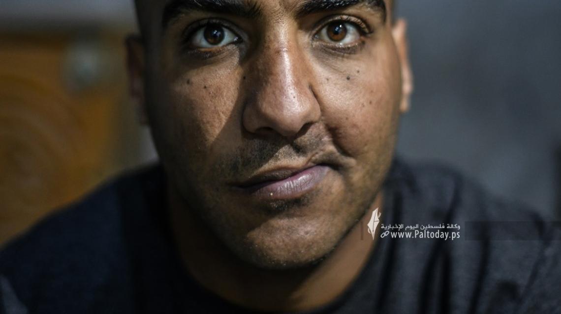 غزة.. قنبلة إسرائيلية تُفقد فلسطينيا فمه وأحلامه