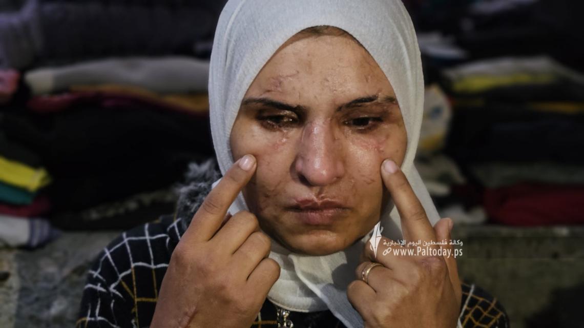 دينا أبو الروس نازحة من شمال غزة فقدت النظر وتعرضت لتشوهات جراء قصف مدفعي على مخيم البريج قبل أشهر