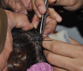 العلاج بسم ولسعات النحل