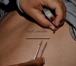 العلاج بسم ولسعات النحل