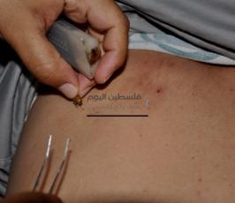 العلاج بسم ولسعات النحل