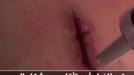 شاهد| غراء طبي يغلق الجروح في ٦٠ ثانية 
