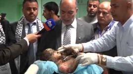 اين ضمير العالم طفلة متفحمة بعد القصف الصهيوني على غزة