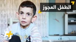 الشيخوخة المبكرة لدى الأطفال....