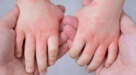 إنفلونزا الطماطم