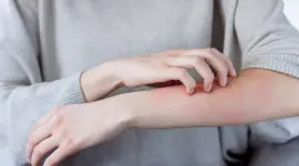 حساسية