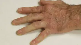 روماتيزم