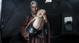 سوء تغذية