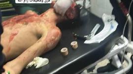 اصابة خطيرةة في بني زيد