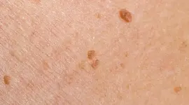 ورم حليمي