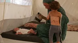 جدري الماء بغزة