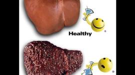 تليف الكبد