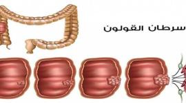 القولون