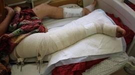 حالات البتر