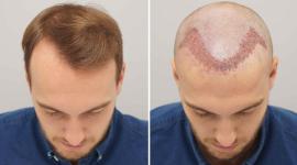 زراعة الشعر