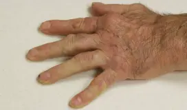 روماتيزم