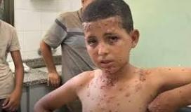 جدري الماء