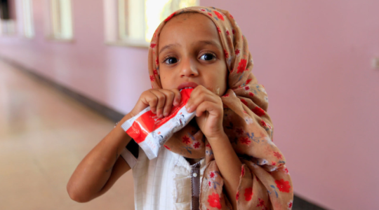 فتاة يمنية تخسر عشرات الكيلوغرامات بسبب سوء التغذية المتفشي في البلاد