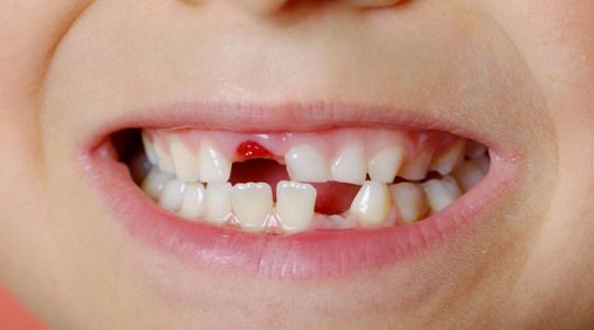 تفسير حلم سقوط الأسنان في المنام- ابن سيرين