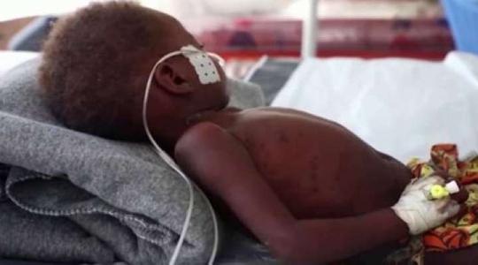 الحصبة تحصد أرواح نحو 150 طفلاً في زيمبابوي