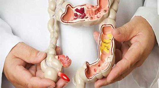 4 "علامات إنذار" لسرطان الأمعاء يمكن أن تظهر قبل التشخيص بسنوات!