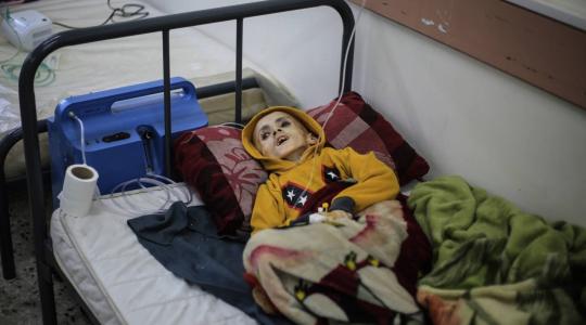 طفل في غزة يعاني من سوء تغذية حاد