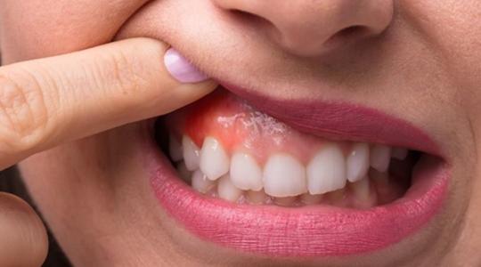 علامات في الفم تكشف عن مشاكل خطيرة