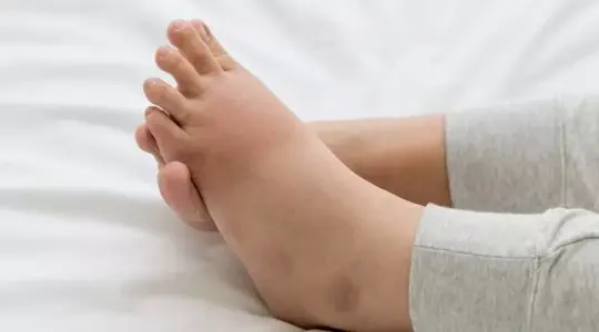 تورم