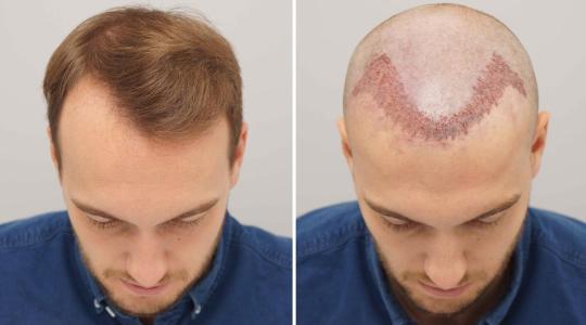 زراعة الشعر