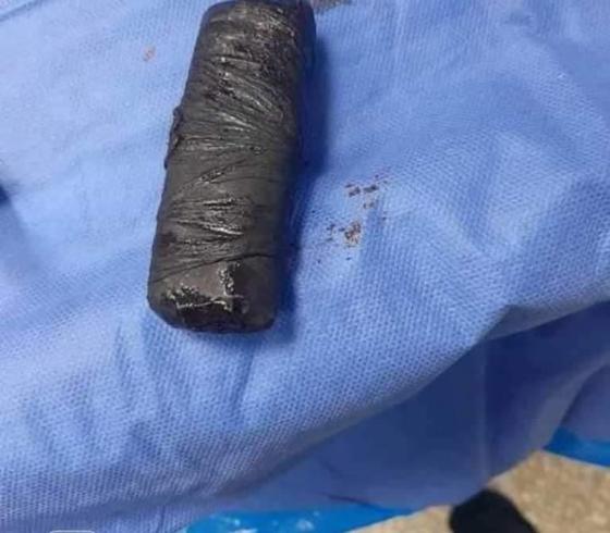 صور: استخراج هاتف من بطن شاب مصري