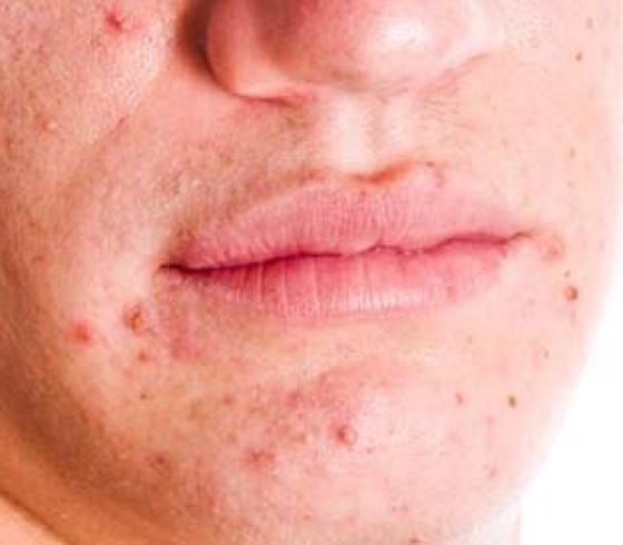 ما هي أسباب ظهور حب الشباب في مرحلة متقدمة من العمر؟