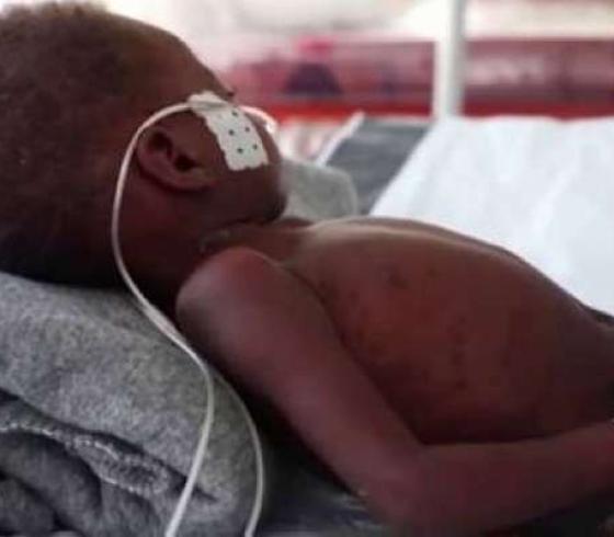 الحصبة تحصد أرواح نحو 150 طفلاً في زيمبابوي