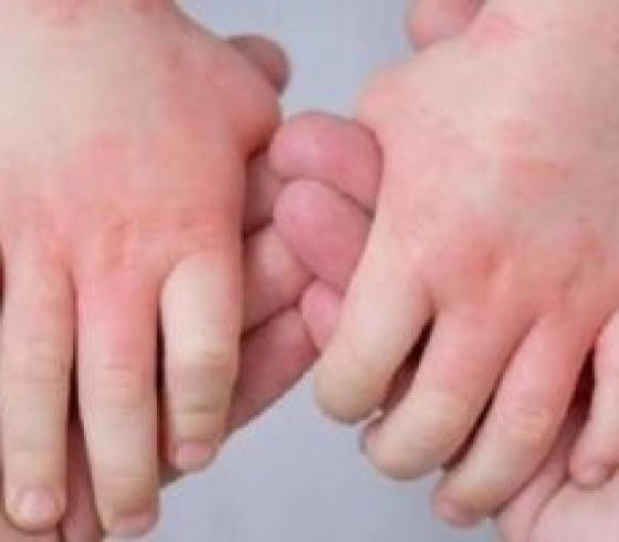 إنفلونزا الطماطم