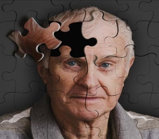 اكتشاف سبب جديد لمرض الزهايمر