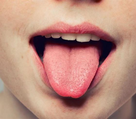 خمسة أعراض تظهر على اللسان