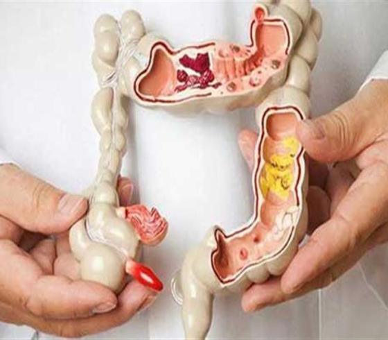 4 "علامات إنذار" لسرطان الأمعاء يمكن أن تظهر قبل التشخيص بسنوات!