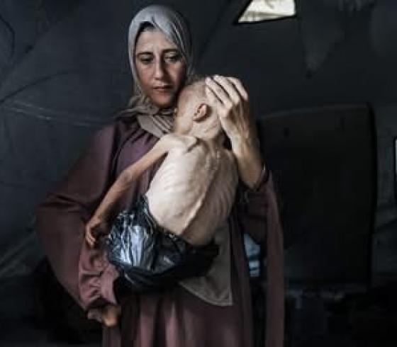 سوء تغذية