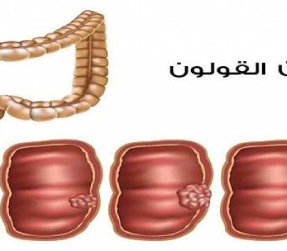 القولون