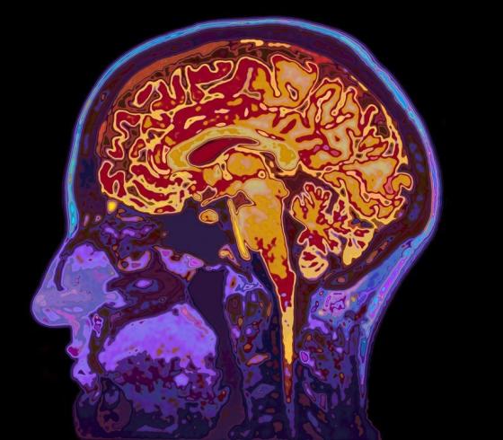 مرض الزهايمر