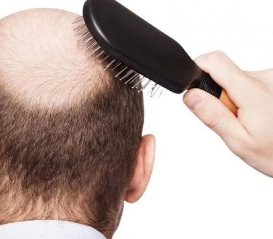 تساقط الشعر