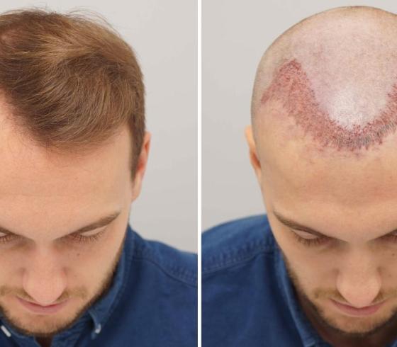 زراعة الشعر