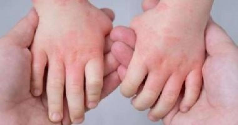 إنفلونزا الطماطم