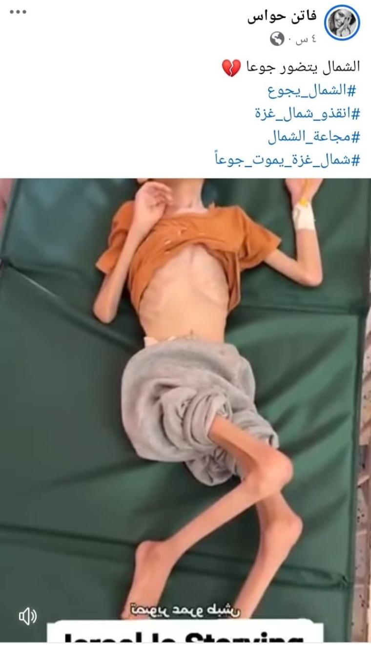بسبب الحصار.. المجاعة تنهش أجساد أطفال غزة والأمراض تُجهز عليها