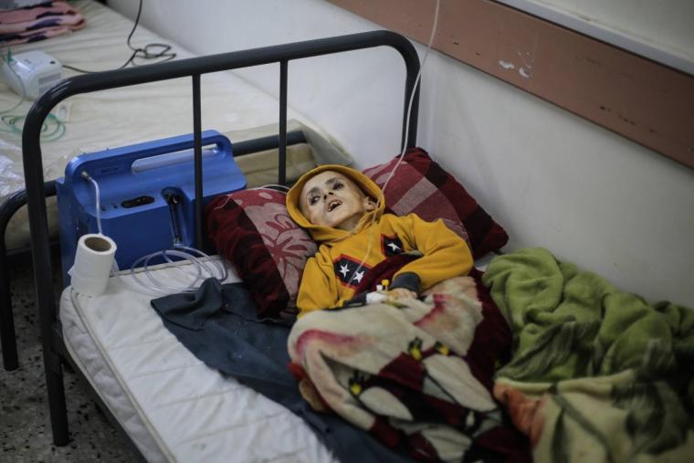 طفل في غزة يعاني من سوء تغذية حاد