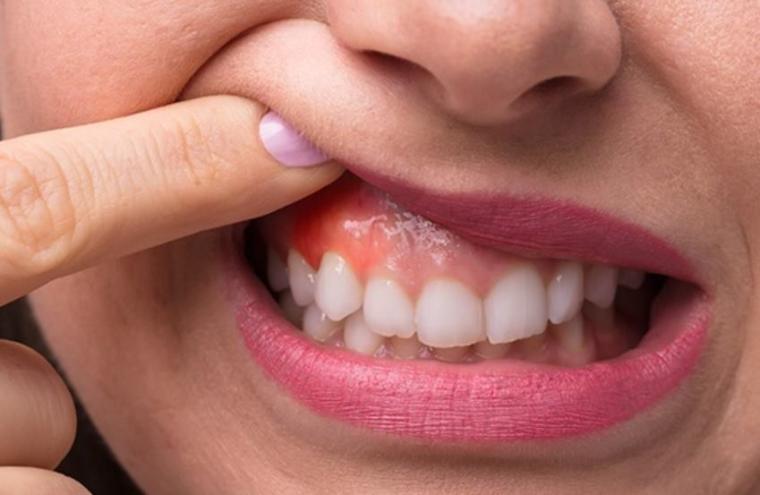 علامات في الفم تكشف عن مشاكل خطيرة