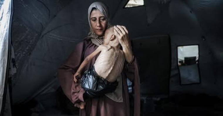 سوء تغذية