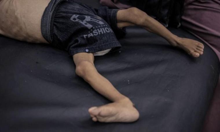 متلازمة غيلان باريه