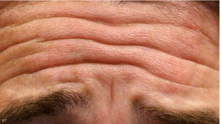 تجاعيد.PNG